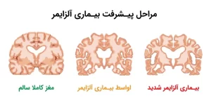 سیر پیشرفت تخریب مغز در آلزایمر